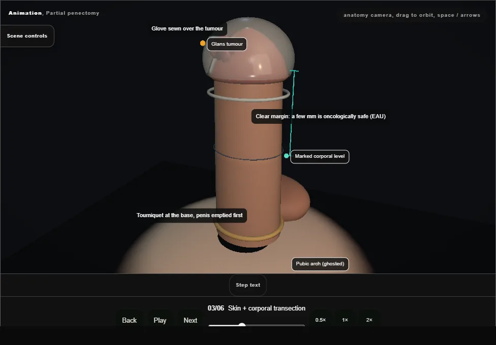 Partial penectomy. Step 3: Skin + corporal transection. Captured frame from the interactive animation.