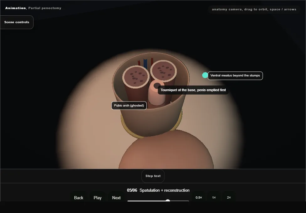 Partial penectomy. Step 5: Spatulation + reconstruction. Captured frame from the interactive animation.