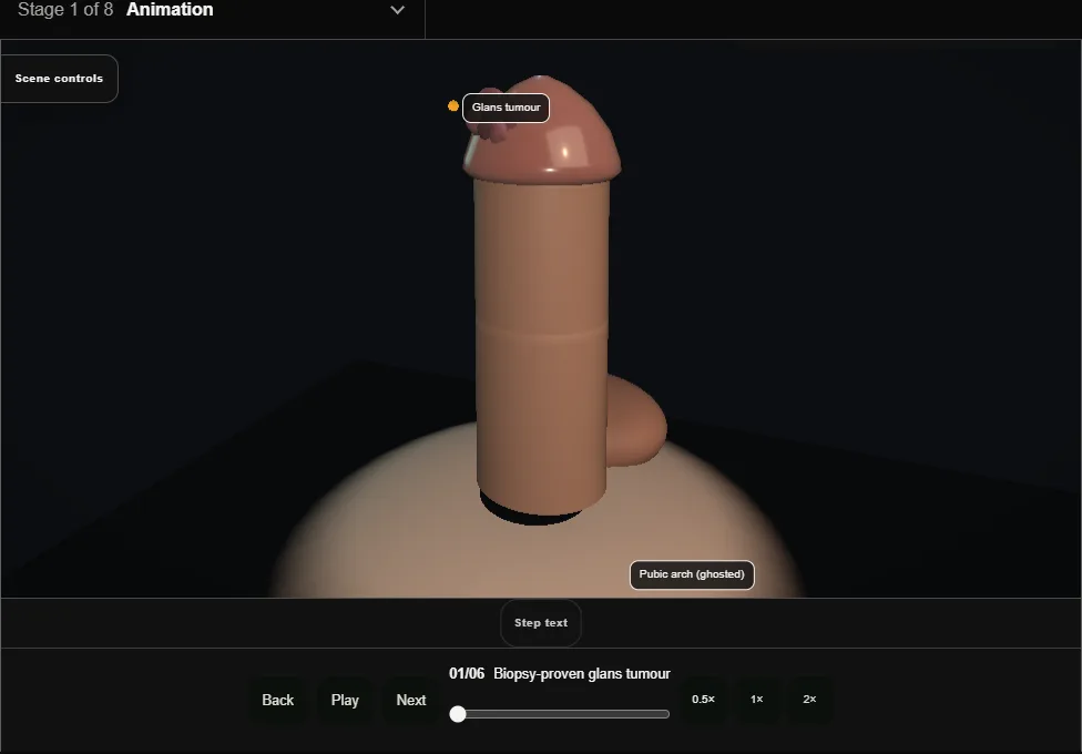 Partial penectomy. Step 1: Biopsy-proven glans tumour. Captured frame from the interactive animation.