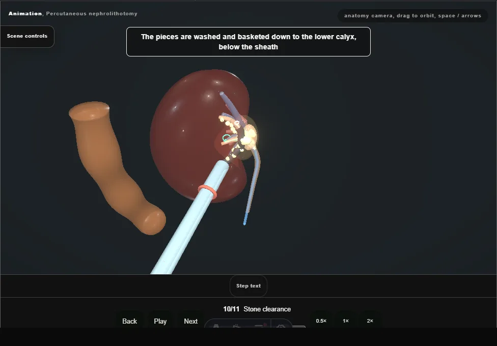Percutaneous nephrolithotomy. Step 10: Stone clearance. Captured frame from the interactive animation.