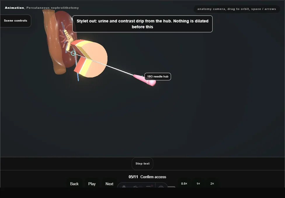 Percutaneous nephrolithotomy. Step 5: Confirm access. Captured frame from the interactive animation.
