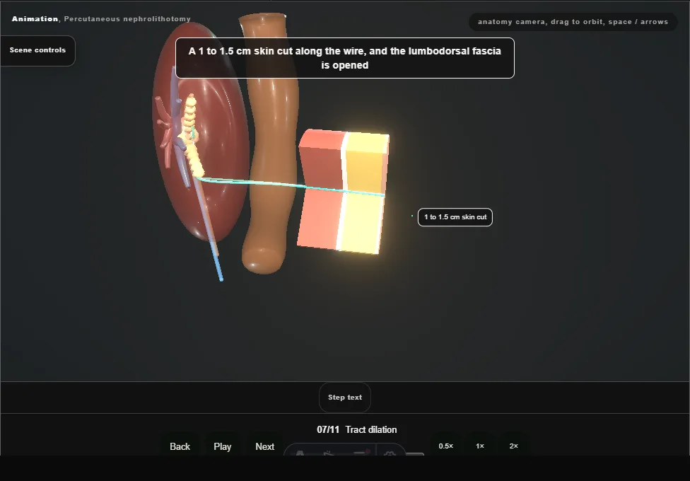 Percutaneous nephrolithotomy. Step 7: Tract dilation. Captured frame from the interactive animation.