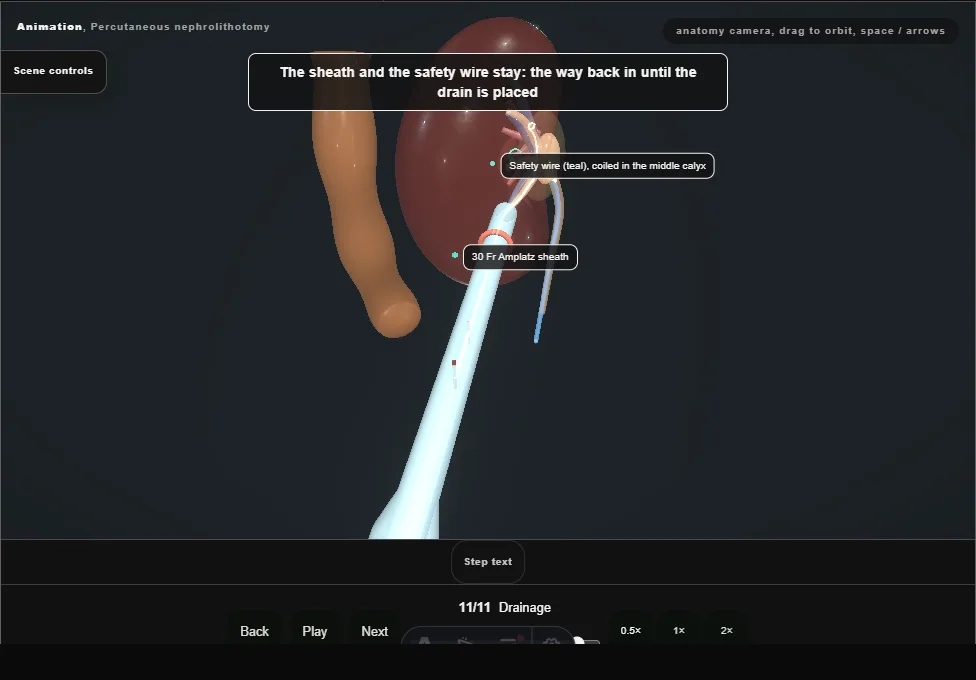 Percutaneous nephrolithotomy. Step 11: Drainage. Captured frame from the interactive animation.