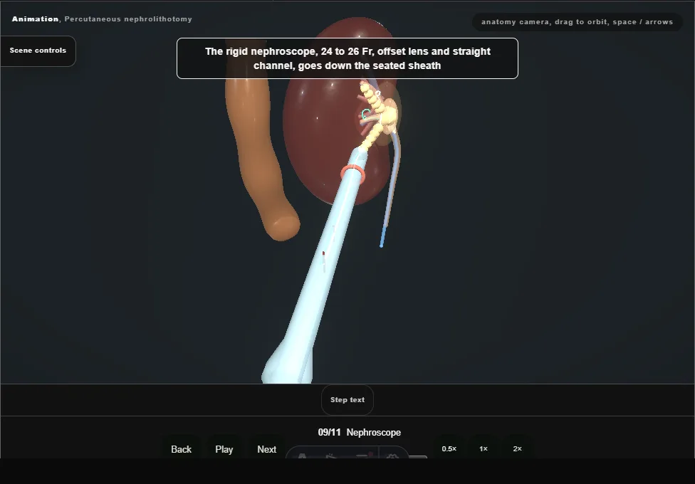 Percutaneous nephrolithotomy. Step 9: Nephroscope. Captured frame from the interactive animation.