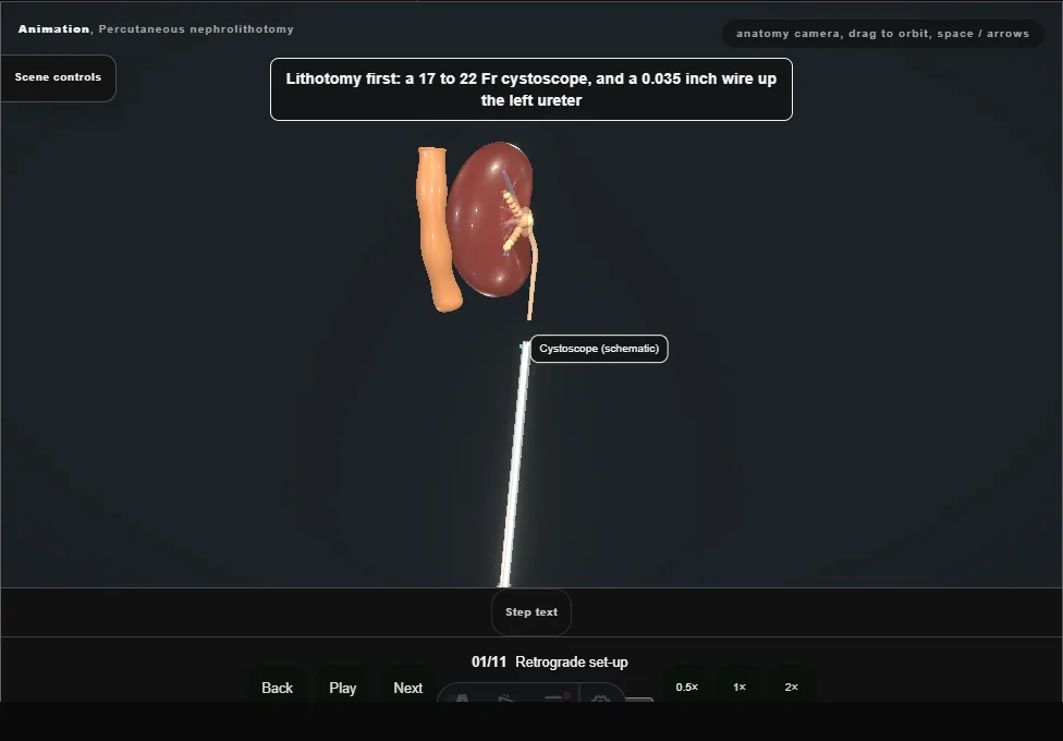 Percutaneous nephrolithotomy. Step 1: Retrograde set-up. Captured frame from the interactive animation.