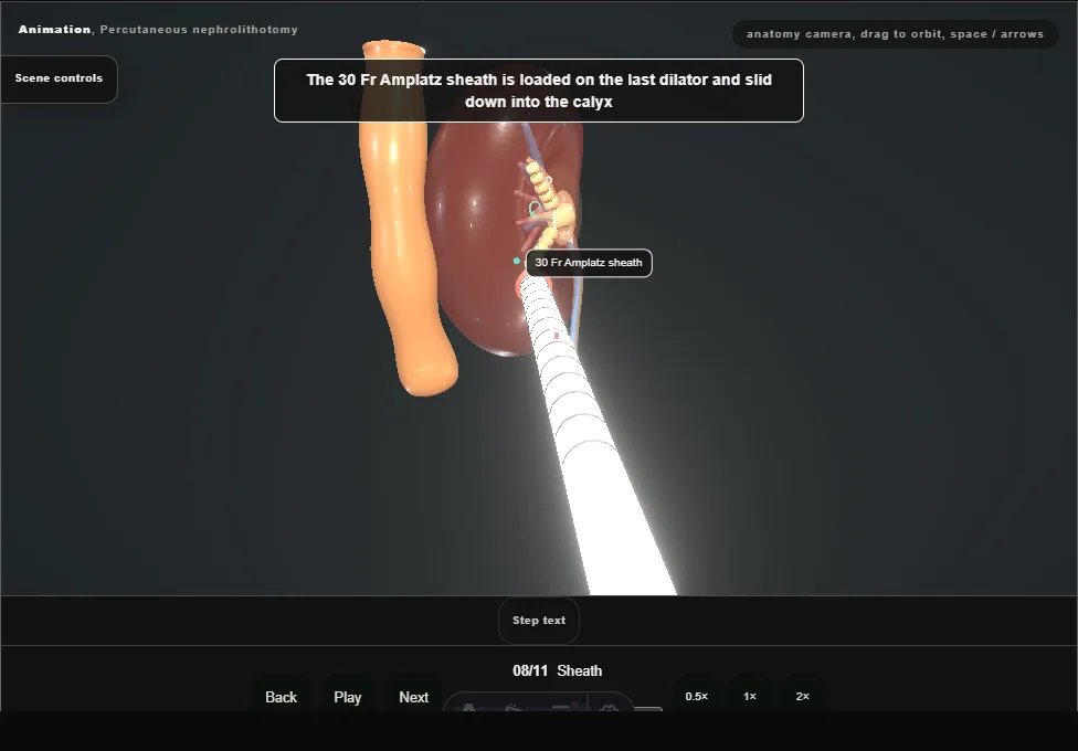 Percutaneous nephrolithotomy. Step 8: Sheath. Captured frame from the interactive animation.