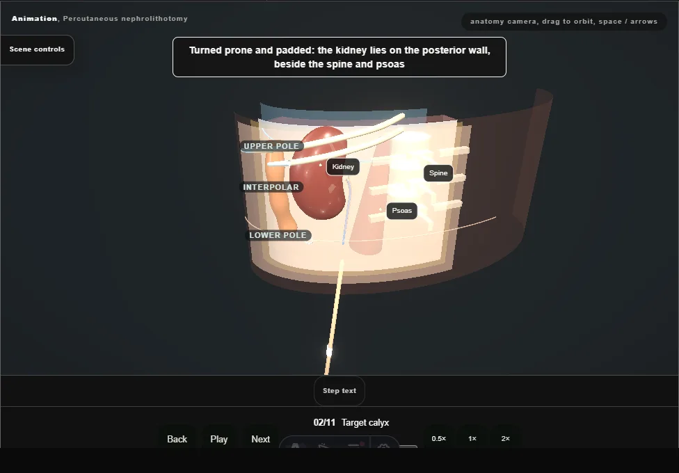 Percutaneous nephrolithotomy. Step 2: Target calyx. Captured frame from the interactive animation.