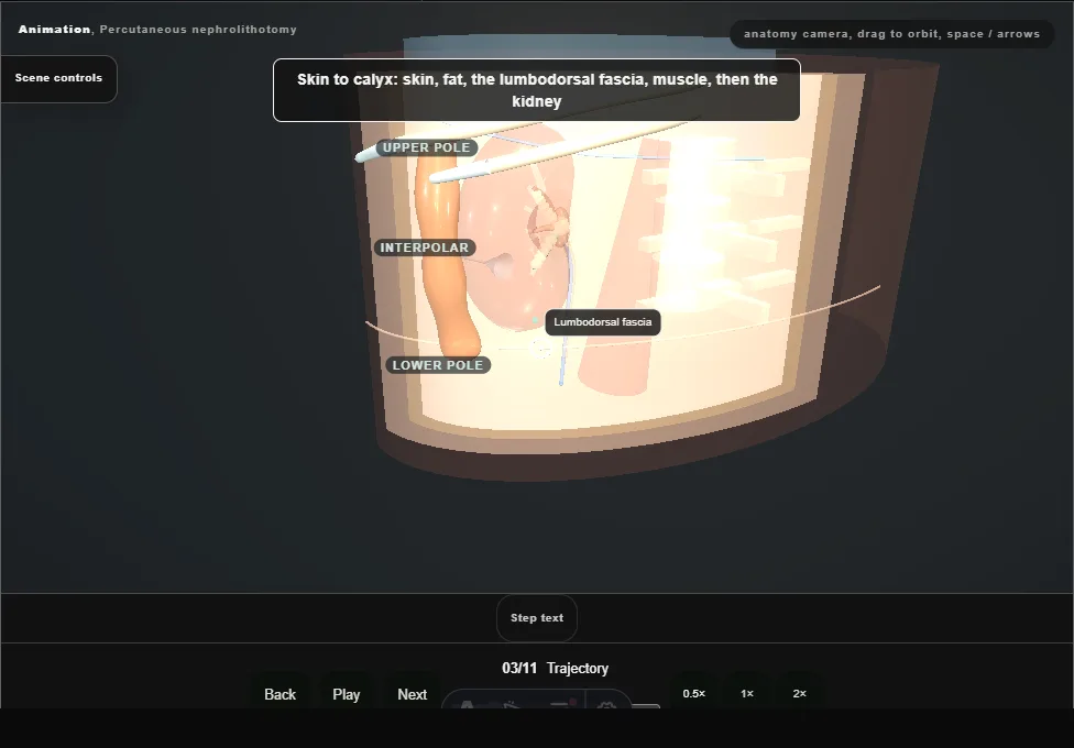 Percutaneous nephrolithotomy. Step 3: Trajectory. Captured frame from the interactive animation.