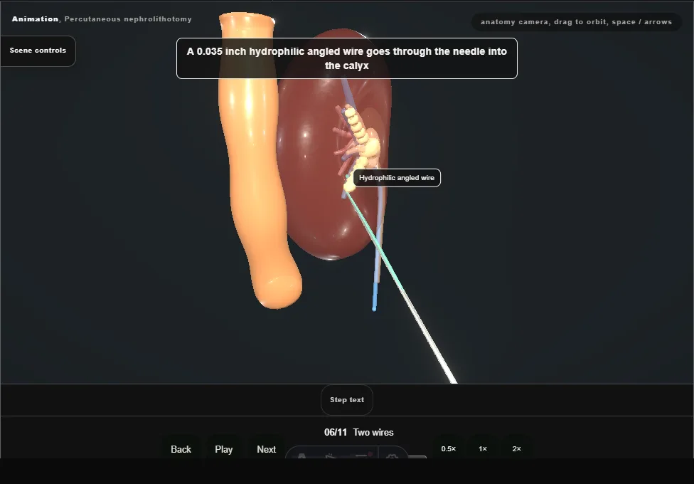 Percutaneous nephrolithotomy. Step 6: Two wires. Captured frame from the interactive animation.