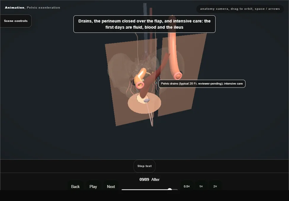 Pelvic exenteration. Step 9: After. Captured frame from the interactive animation.