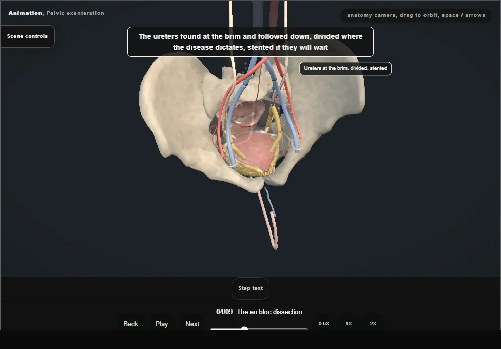 Pelvic exenteration. Step 4: The en bloc dissection. Captured frame from the interactive animation.