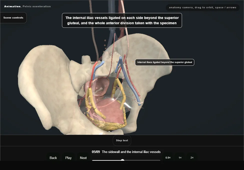 Pelvic exenteration. Step 5: The sidewall and the internal iliac vessels. Captured frame from the interactive animation.