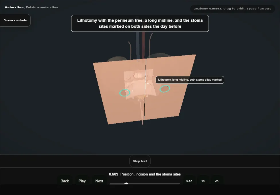 Pelvic exenteration. Step 3: Position, incision and the stoma sites. Captured frame from the interactive animation.