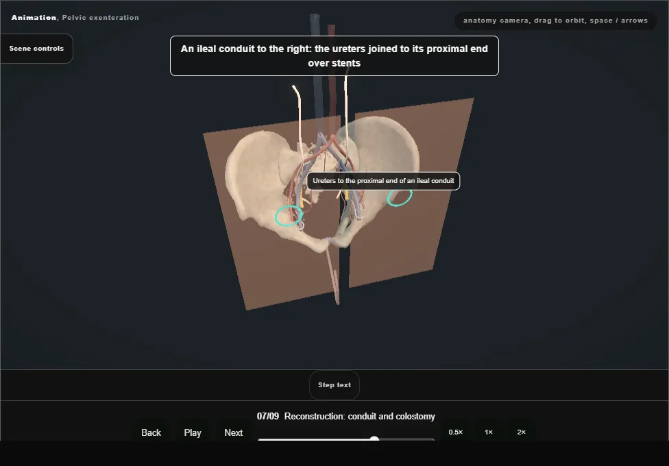 Pelvic exenteration. Step 7: Reconstruction: conduit and colostomy. Captured frame from the interactive animation.