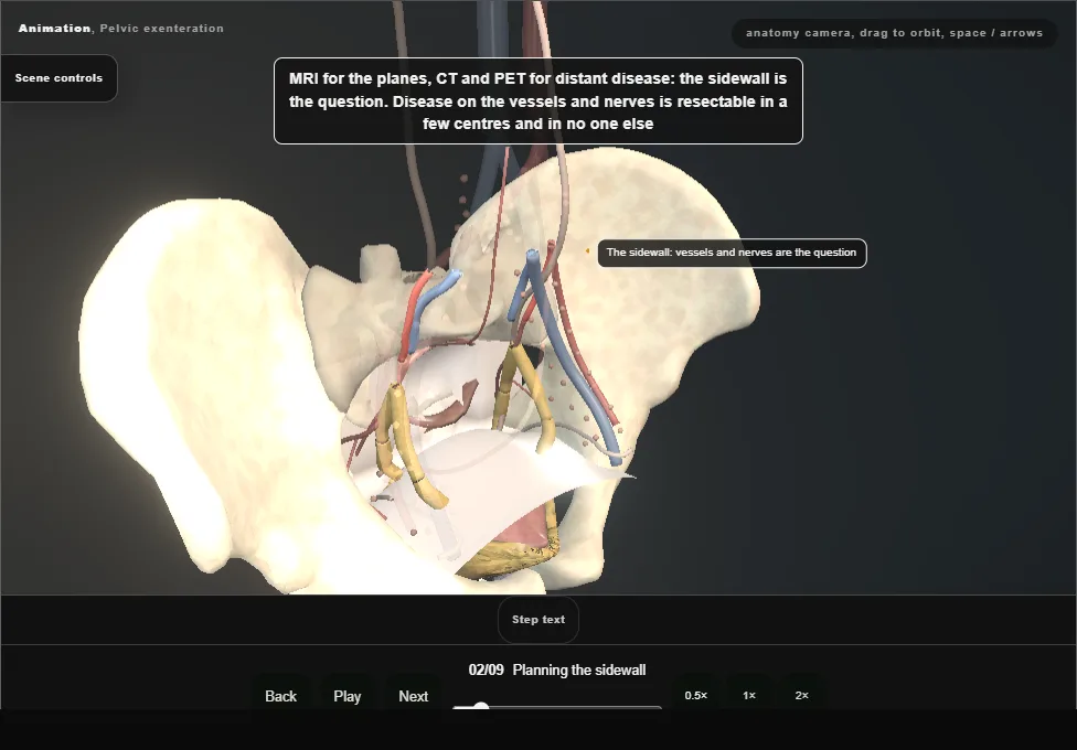 Pelvic exenteration. Step 2: Planning the sidewall. Captured frame from the interactive animation.