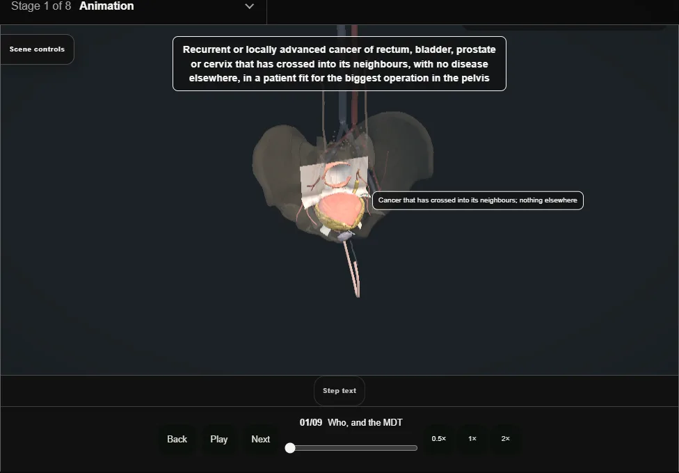 Pelvic exenteration. Step 1: Who, and the MDT. Captured frame from the interactive animation.