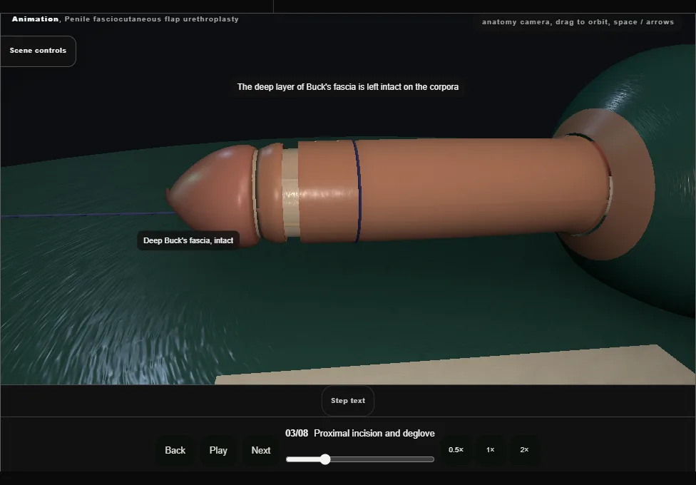 Penile fasciocutaneous flap urethroplasty. Step 3: Proximal incision and deglove. Captured frame from the interactive animation.