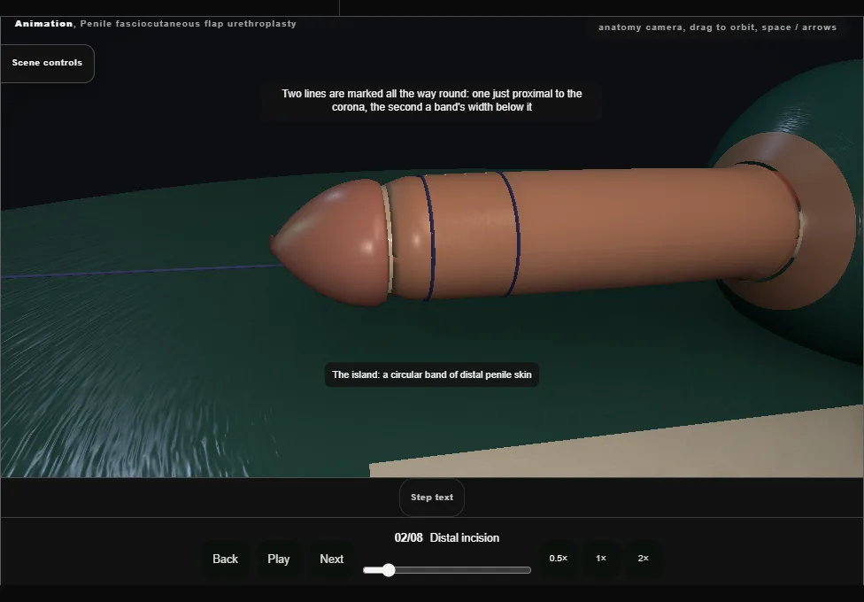 Penile fasciocutaneous flap urethroplasty. Step 2: Distal incision. Captured frame from the interactive animation.