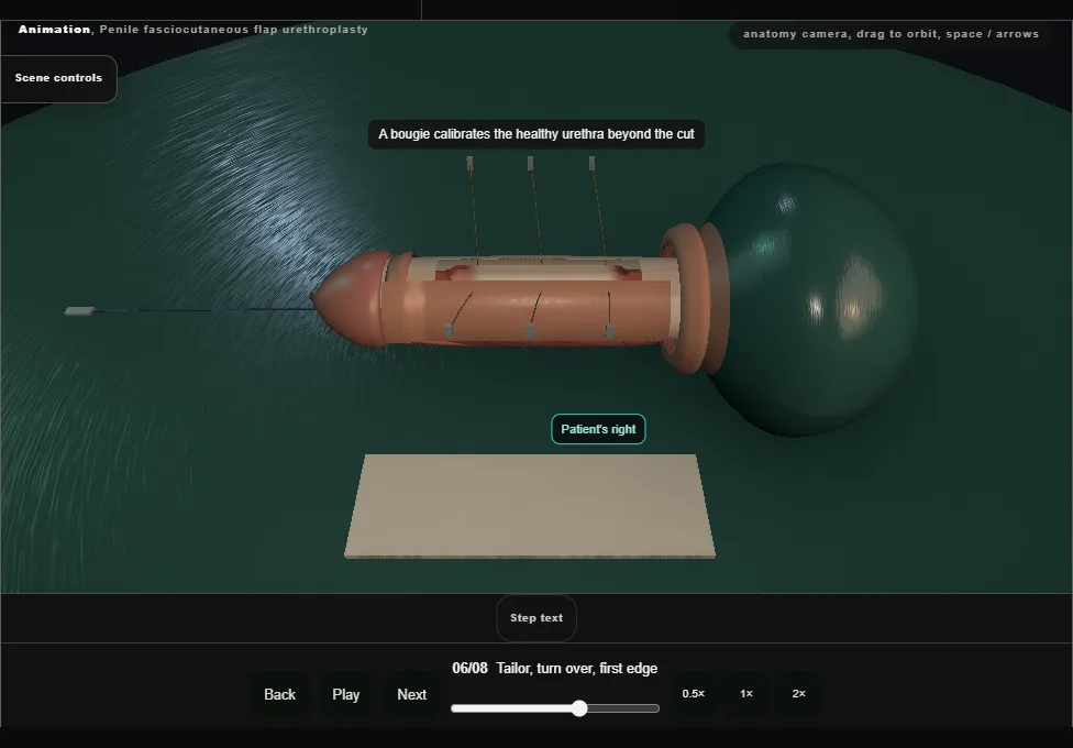 Penile fasciocutaneous flap urethroplasty. Step 6: Tailor, turn over, first edge. Captured frame from the interactive animation.