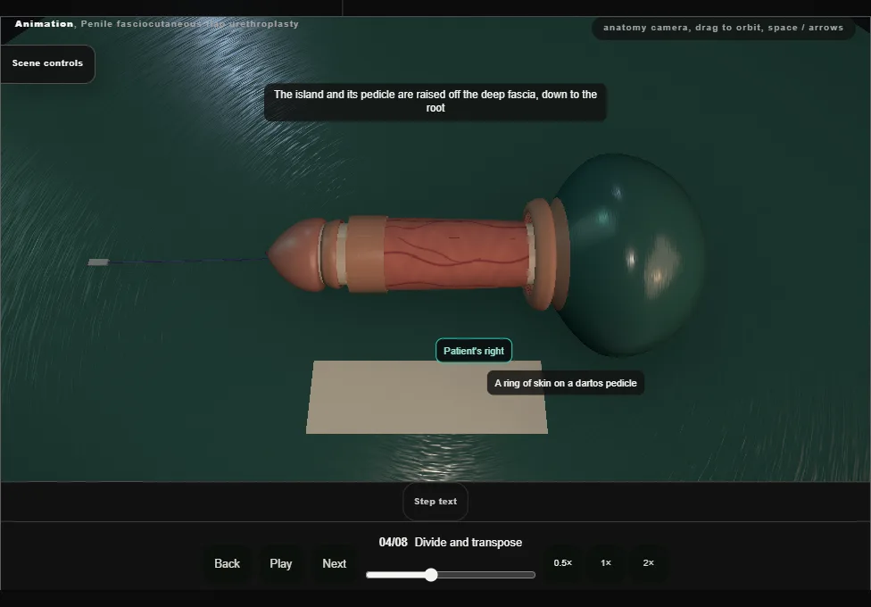 Penile fasciocutaneous flap urethroplasty. Step 4: Divide and transpose. Captured frame from the interactive animation.