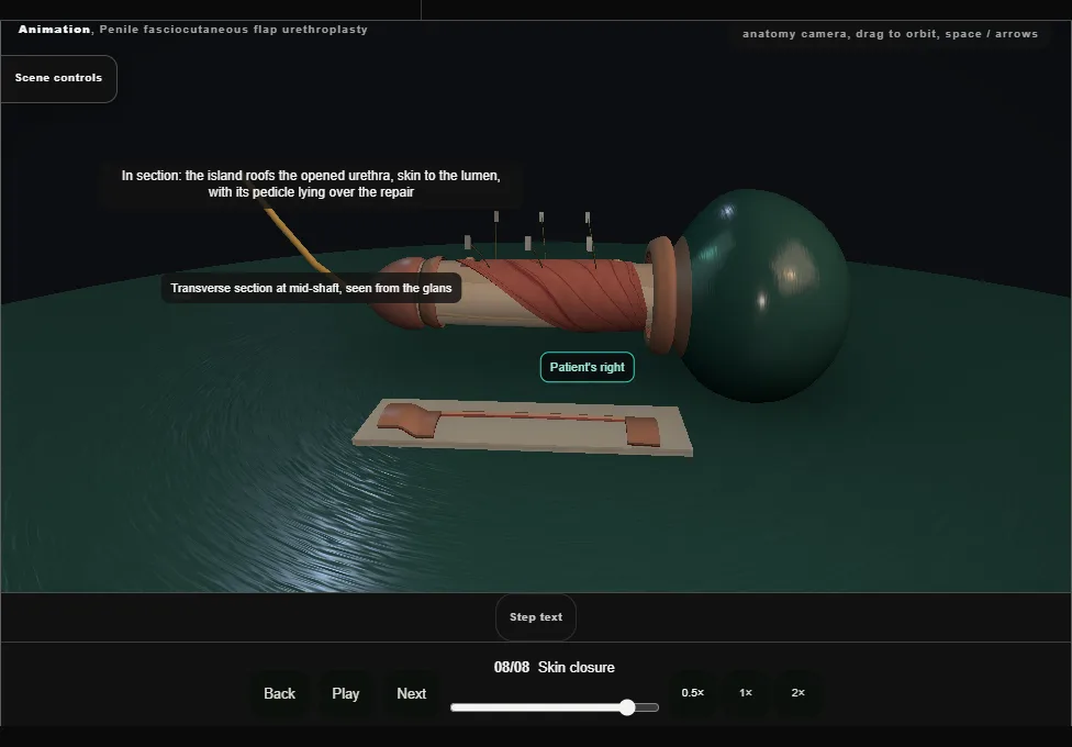 Penile fasciocutaneous flap urethroplasty. Step 8: Skin closure. Captured frame from the interactive animation.
