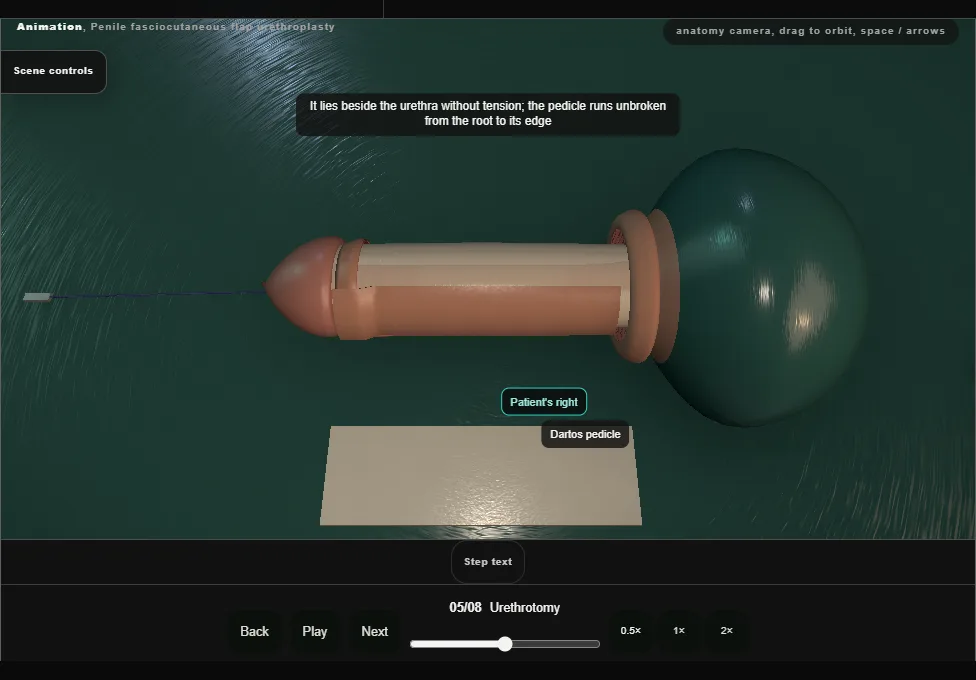 Penile fasciocutaneous flap urethroplasty. Step 5: Urethrotomy. Captured frame from the interactive animation.
