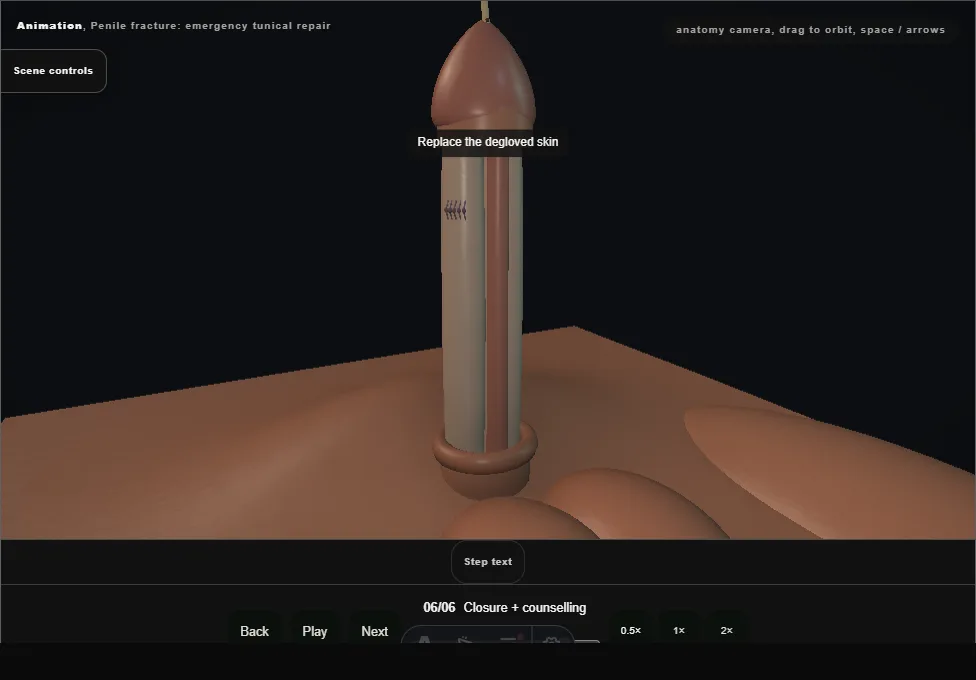 Penile fracture: emergency tunical repair. Step 6: Closure + counselling. Captured frame from the interactive animation.