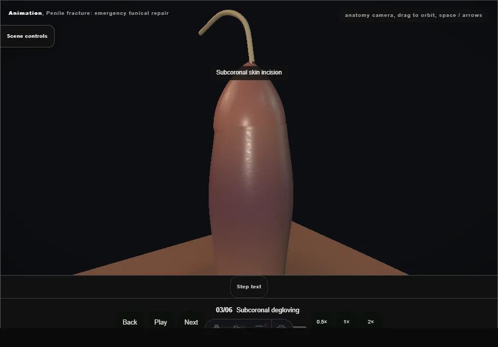 Penile fracture: emergency tunical repair. Step 3: Subcoronal degloving. Captured frame from the interactive animation.