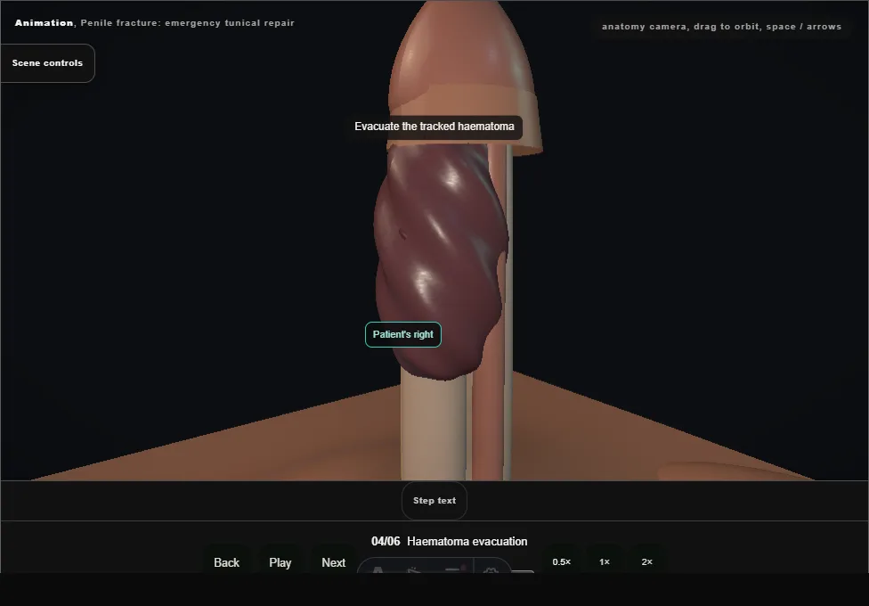 Penile fracture: emergency tunical repair. Step 4: Haematoma evacuation. Captured frame from the interactive animation.