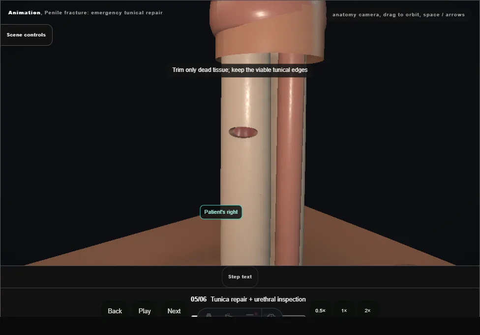 Penile fracture: emergency tunical repair. Step 5: Tunica repair + urethral inspection. Captured frame from the interactive animation.