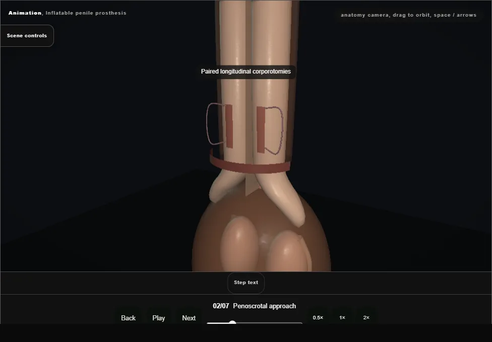 Inflatable penile prosthesis. Step 2: Penoscrotal approach. Captured frame from the interactive animation.