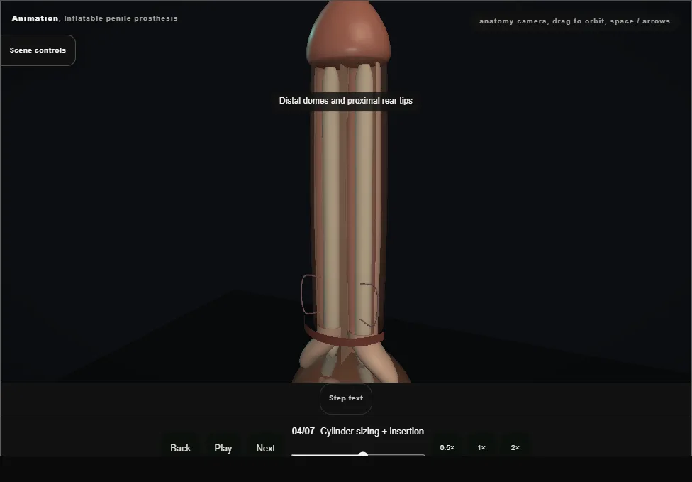 Inflatable penile prosthesis. Step 4: Cylinder sizing + insertion. Captured frame from the interactive animation.