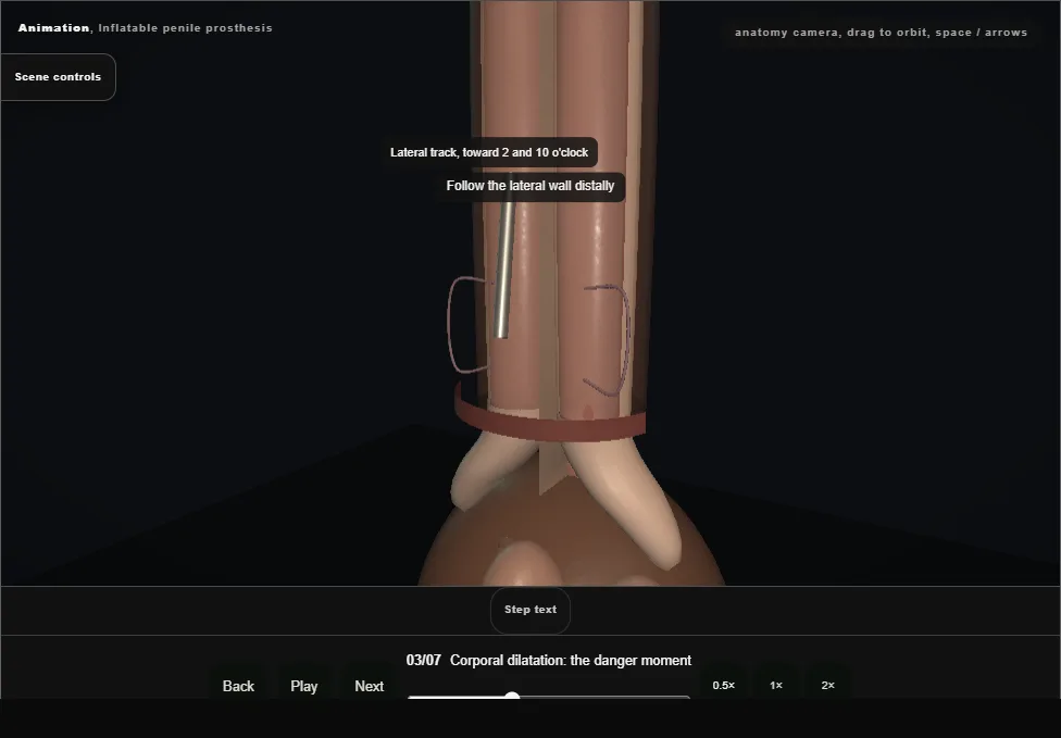Inflatable penile prosthesis. Step 3: Corporal dilatation: the danger moment. Captured frame from the interactive animation.