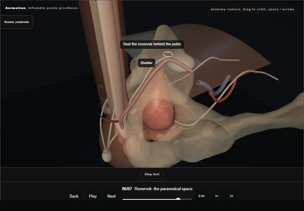 Inflatable penile prosthesis. Step 6: Reservoir: the paravesical space. Captured frame from the interactive animation.