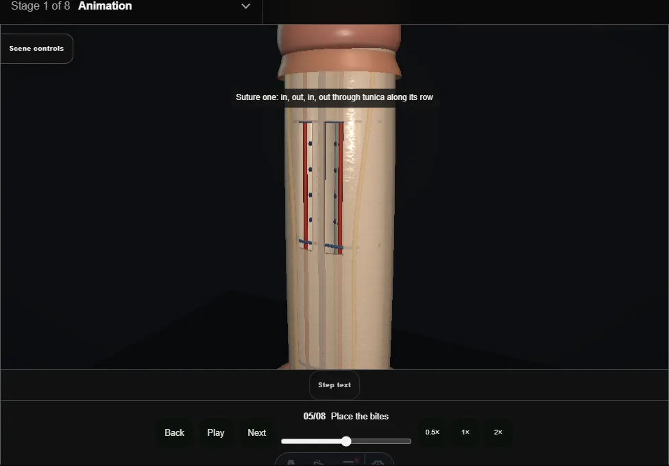 Penile curvature: Lue sixteen-dot plication. Step 5: Place the bites. Captured frame from the interactive animation.