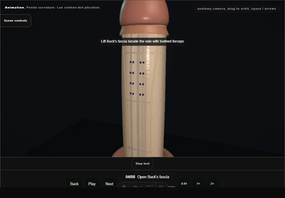 Penile curvature: Lue sixteen-dot plication. Step 4: Open Buck's fascia. Captured frame from the interactive animation.