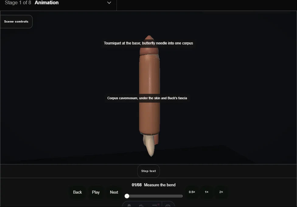 Penile curvature: Lue sixteen-dot plication. Step 1: Measure the bend. Captured frame from the interactive animation.