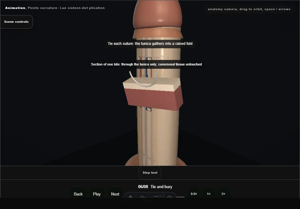 Penile curvature: Lue sixteen-dot plication. Step 6: Tie and bury. Captured frame from the interactive animation.