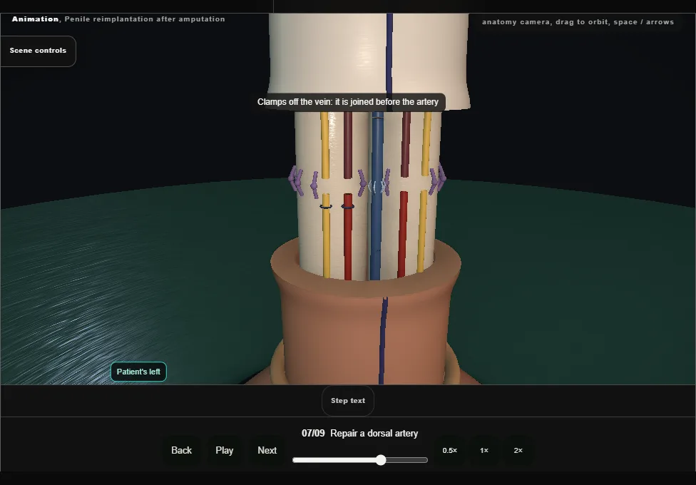 Penile reimplantation after amputation. Step 7: Repair a dorsal artery. Captured frame from the interactive animation.