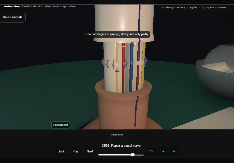 Penile reimplantation after amputation. Step 8: Repair a dorsal nerve. Captured frame from the interactive animation.