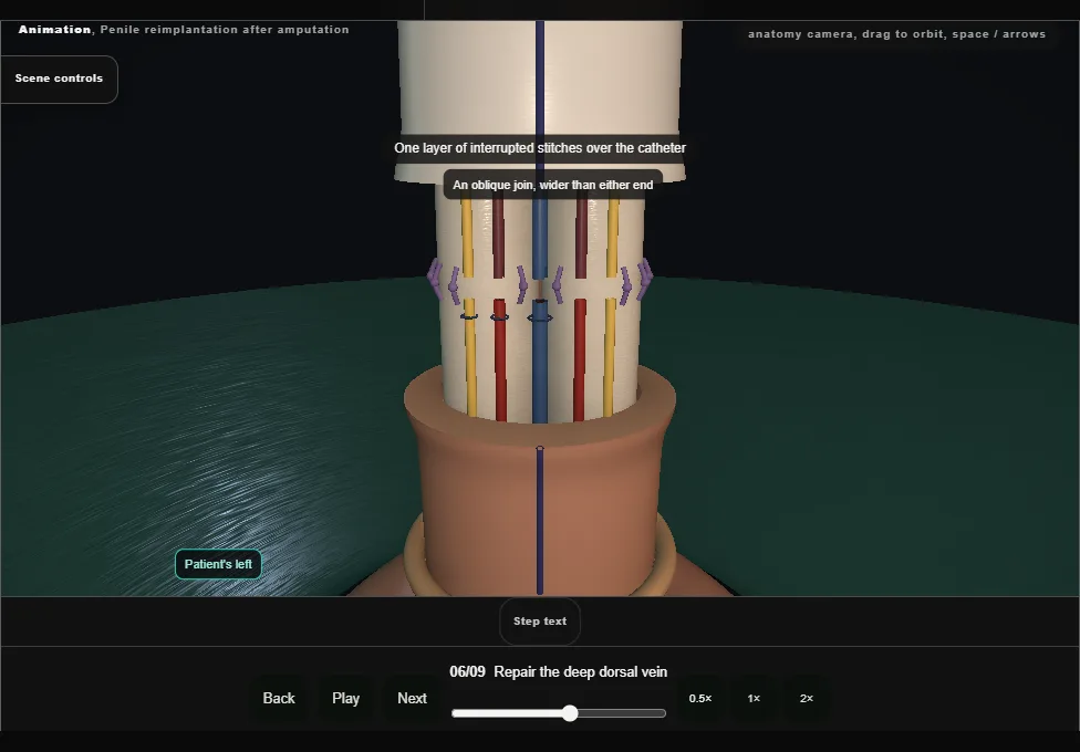 Penile reimplantation after amputation. Step 6: Repair the deep dorsal vein. Captured frame from the interactive animation.