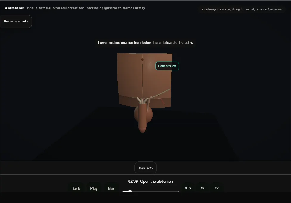 Penile arterial revascularisation: inferior epigastric to dorsal artery. Step 2: Open the abdomen. Captured frame from the interactive animation.