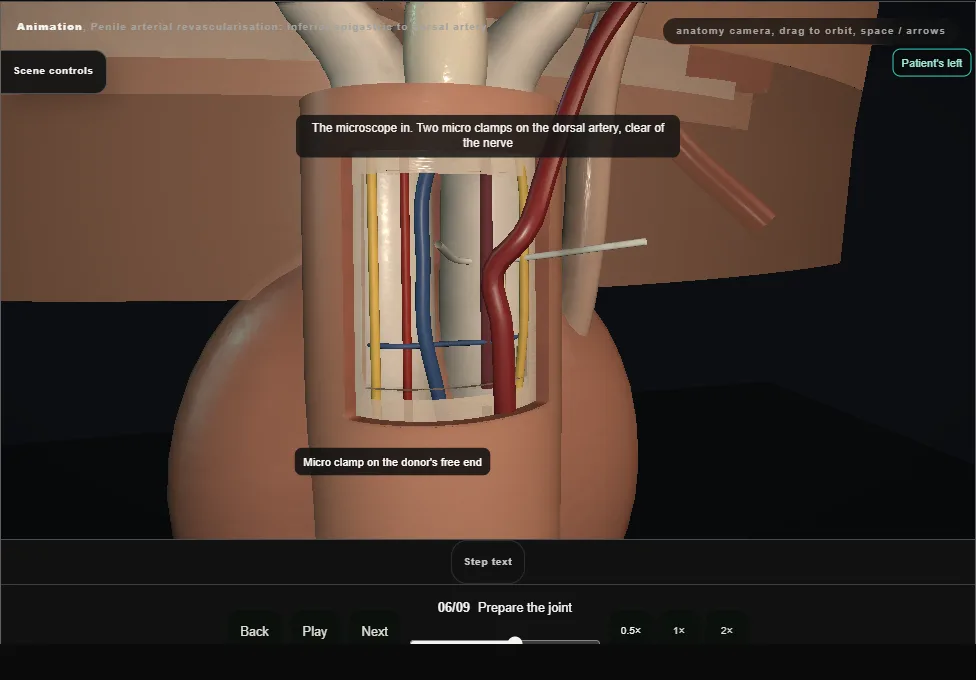 Penile arterial revascularisation: inferior epigastric to dorsal artery. Step 6: Prepare the joint. Captured frame from the interactive animation.
