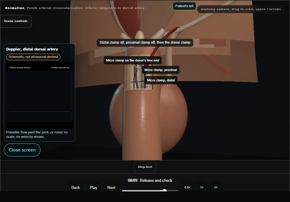 Penile arterial revascularisation: inferior epigastric to dorsal artery. Step 8: Release and check. Captured frame from the interactive animation.