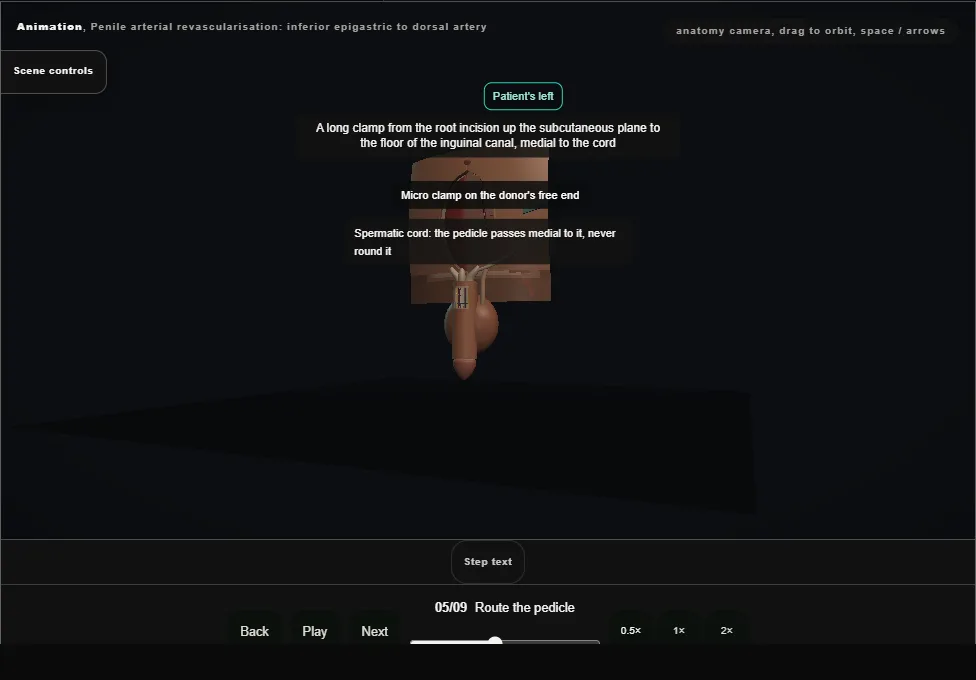 Penile arterial revascularisation: inferior epigastric to dorsal artery. Step 5: Route the pedicle. Captured frame from the interactive animation.