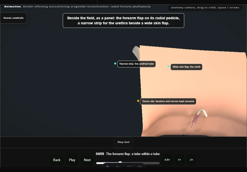 Gender-affirming masculinising urogenital reconstruction: radial forearm phalloplasty. Step 4: The forearm flap: a tube within a tube. Captured frame from the interactive animation.
