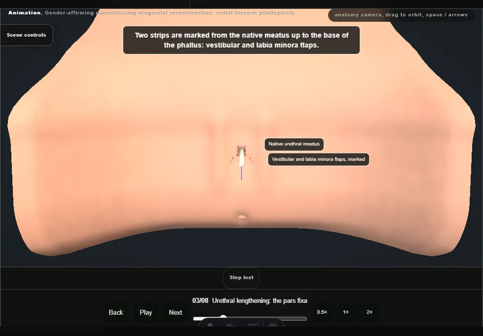 Gender-affirming masculinising urogenital reconstruction: radial forearm phalloplasty. Step 3: Urethral lengthening: the pars fixa. Captured frame from the interactive animation.