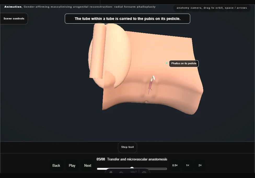 Gender-affirming masculinising urogenital reconstruction: radial forearm phalloplasty. Step 5: Transfer and microvascular anastomosis. Captured frame from the interactive animation.