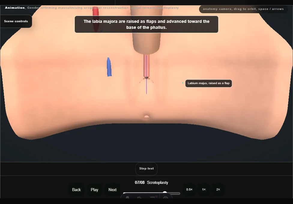 Gender-affirming masculinising urogenital reconstruction: radial forearm phalloplasty. Step 7: Scrotoplasty. Captured frame from the interactive animation.