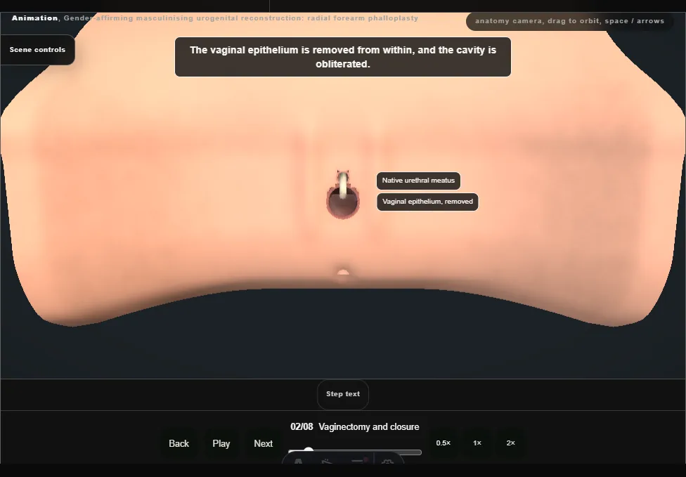 Gender-affirming masculinising urogenital reconstruction: radial forearm phalloplasty. Step 2: Vaginectomy and closure. Captured frame from the interactive animation.